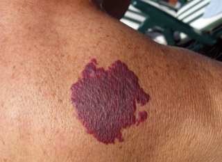 Когда у детей появляются родинки: в каком возрасте, можно ли удалять, к кому обратиться?