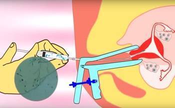 Искусственная инсеминация в домашних условиях: подготовка женщины к процедуре, правила ее выполнения