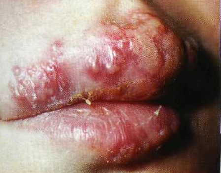 У ребенка опухла губа: причины, сопутствующие симптомы и лечение