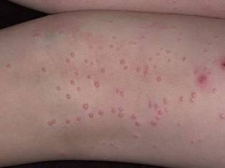 Аллергия у ребенка: фото, симптомы и лечение, профилактика кожных аллергических реакций