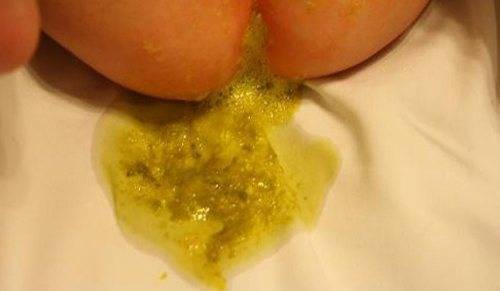 Прожилки крови в кале у грудничка на грудном вскармливании (Комаровский)