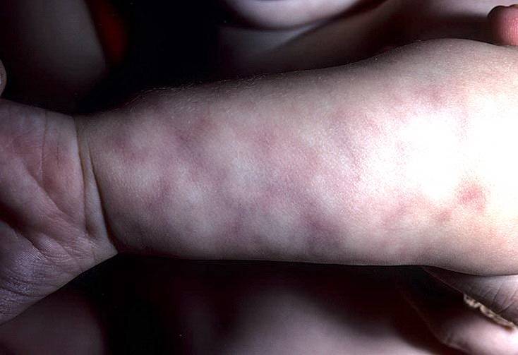 Мраморная кожа у грудничка: причины мраморности кожных покровов и лечение