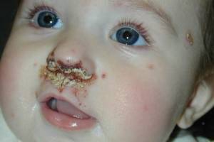 Герпес на лице у ребенка: фото и лечение "простуды" на щеках, лбу