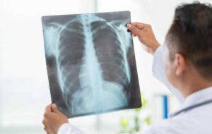 Пневмония у детей: как распознать первые симптомы воспаления легких и вовремя начать лечение?