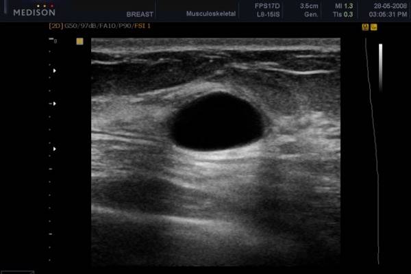Ультразвук при лактостазе, физиотерапия: можно ли делать УЗИ при грудном вскармливании?
