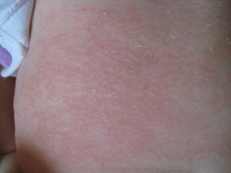 Почему на коже появилось шершавое пятно: причины сыпи на теле (спине, пояснице, плечах) у взрослого и ребенка