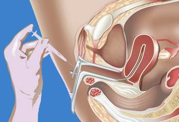Искусственная инсеминация в домашних условиях: подготовка женщины к процедуре, правила ее выполнения