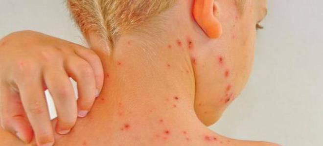 Фукорцин для детей: инструкция по применению при стрептодермии, ветрянке, опрелостях