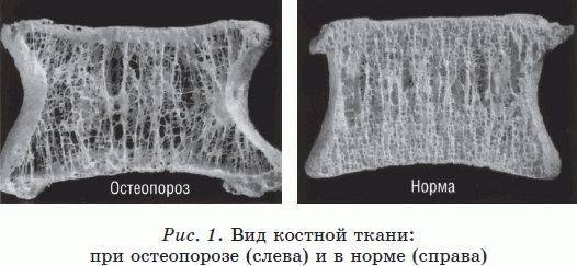 Остеопороз у детей: симптомы и лечение ювенильной формы патологии