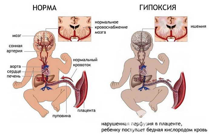 Отек головного мозга у новорожденных - возможные последствия для ребенка