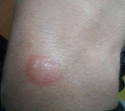 У ребенка на языке пятна: красные, как ожог (фото, диагноз, лечение и причины)