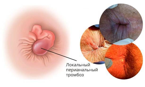Геморрой у детей от 2 лет: как лечить патологию на начальной стадии с помощью свечей?