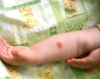 Как уменьшить Манту на руке в домашних условиях - можно ли мазать "Фенистилом" и другими средствами?