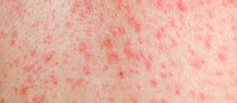 Сыпь после температуры у ребенка: фото, причины и лечение (Комаровский)