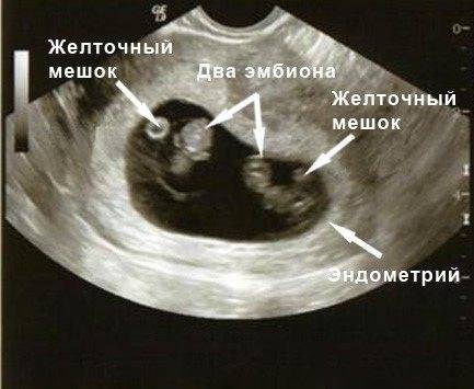 Желточный мешок: норма по неделям беременности, размеры на ранних и поздних сроках