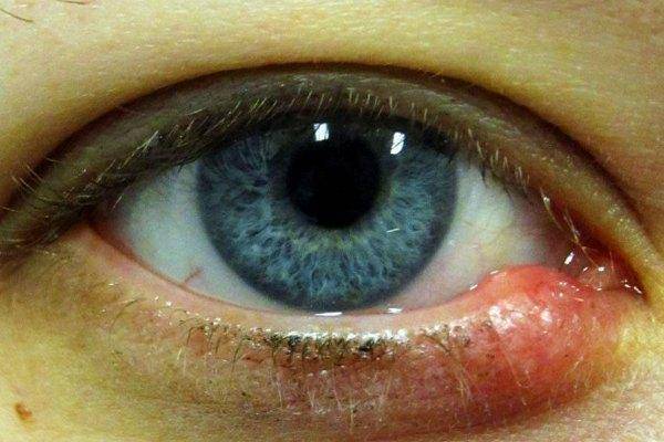 У ребенка красные глаза: причины и лечение, сопутствующие симптомы - гной, аллергия