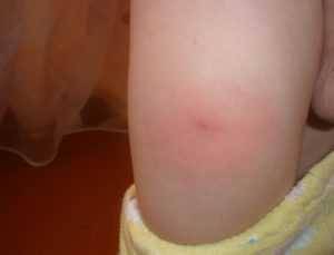 После прививки АКДС у ребенка болит нога, он хромает и не может встать – что делать?