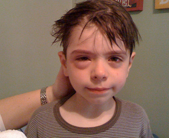 Как узнать на что аллергия у ребенка: способы определения потенциального аллергена