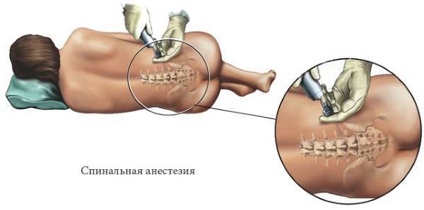 Кесарево сечение при тазовом предлежании: когда делают, как проходит, какие плюсы и минусы операции?