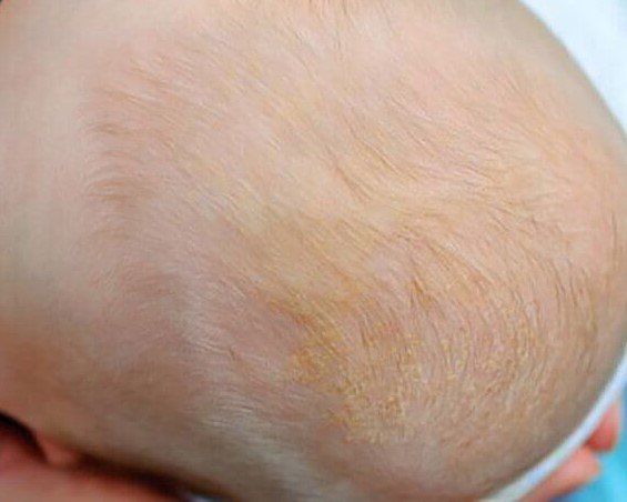 Топ-5 лучших шампуней от корочек на голове у ребенка. советы по выбору и правила использования