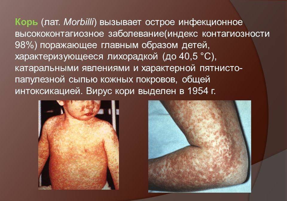 У ребенка гнойные прыщики на теле: причины возникновения, симптомы и лечение