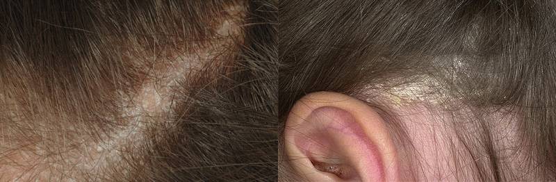 У ребенка выпадают волосы - что делать, почему это происходит, какое необходимо лечение?