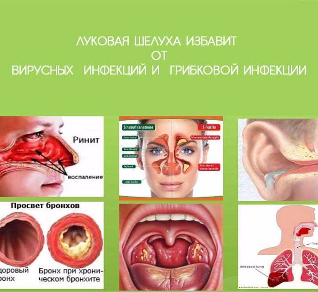 Бактериальная ангина: симптомы, лечение у взрослых и детей
