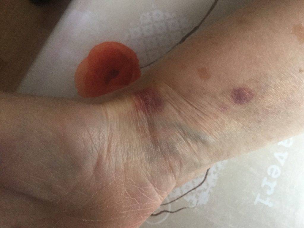 Шершавые пятна на теле у ребенка (на коже ног и рук, на спине и лице): фото