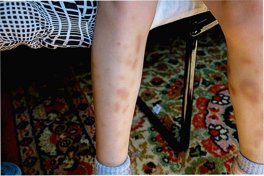 Синяки на ногах у ребенка без причины - что это и почему постоянно появляются пятна?