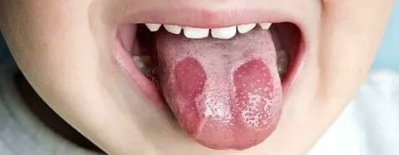 Средства для лечения стоматита во рту у детей: лучшие мази, гели, спреи и таблетки
