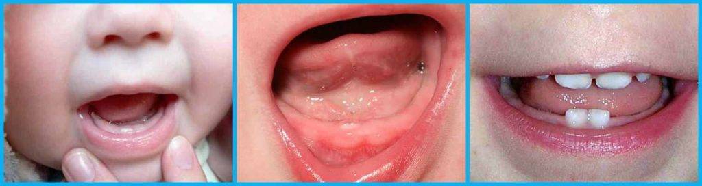 Сроки прорезывания постоянных зубов у детей: таблица смены молочных единиц коренными