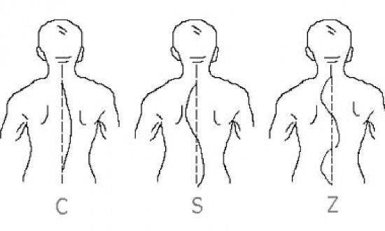 Как выполнять массаж спины при сколиозе (искривлении позвоночника) у детей?