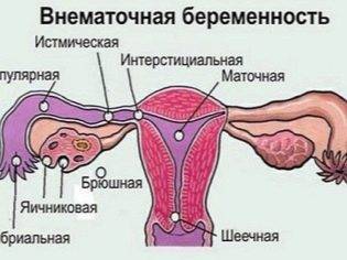 Как улучшить кровоток в матке при планировании беременности и перед переносом эмбрионов для ЭКО?