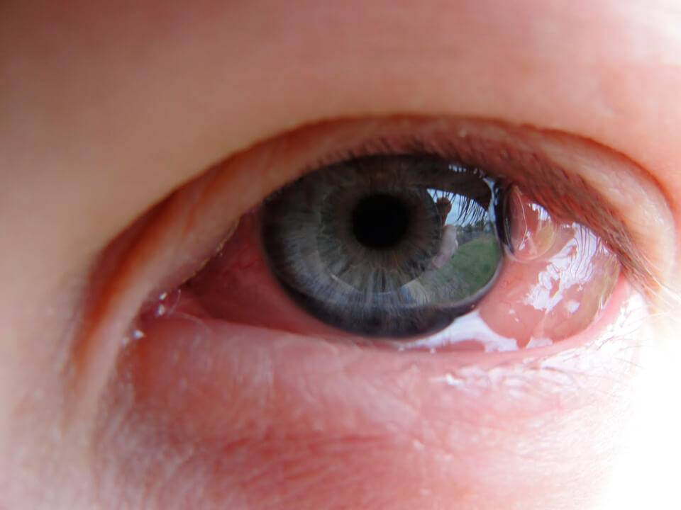 Гноится глаз у новорожденного - что делать, как и чем правильно лечить?