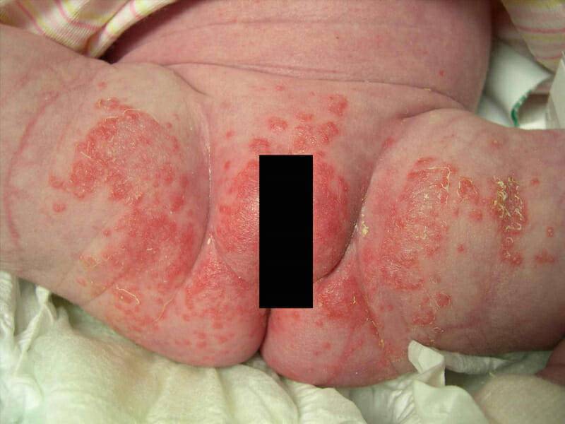 Можно ли при молочнице забеременеть: возможно ли зачатие, какой будет беременность?