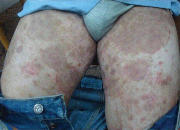 Сыпь в паху у ребенка - раздражение в интимной зоне, покраснение и зуд на половых органах