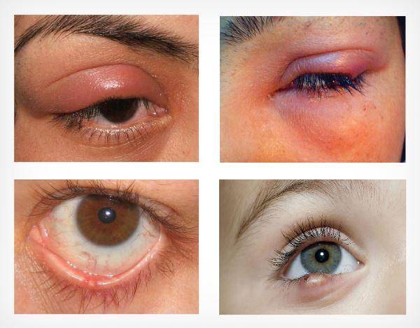 Как лечить ячмень на глазу у ребенка в домашних условиях: быстрые способы терапии чирей