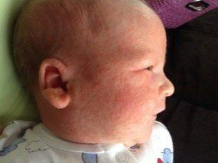 Гормональная сыпь у новорожденных: фото трехнедельных неонатальных прыщиков у детей