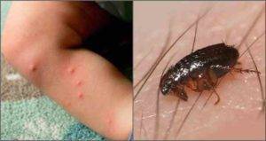 Чем мазать укусы блох у детей: симптомы и лечение аллергии, фото, обработка кожи