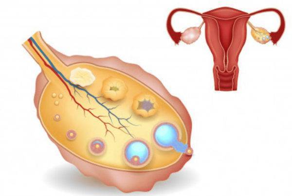 Можно ли забеременеть с одним яичником: какова вероятность зачать и родить?