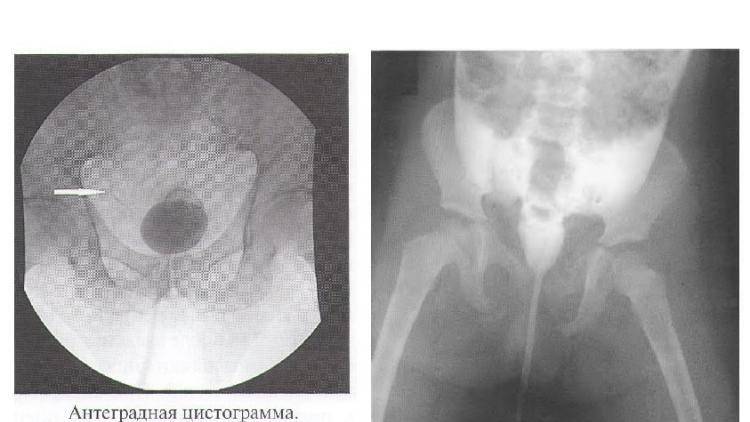 Цистография у детей - как делается, какая нужна подготовка и каковы последствия для ребенка?