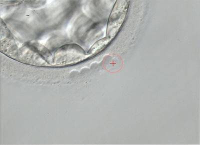 Хетчинг эмбрионов: что это такое, для чего проводится, возможны ли осложнения?