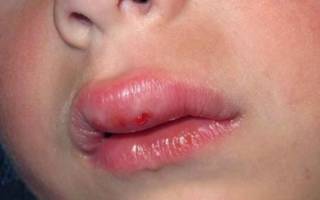 У ребенка опухла губа: причины, сопутствующие симптомы и лечение