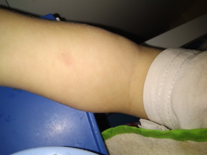 Положительная реакция Манту: что это значит и что делать родителям ребенка?