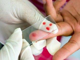 Тромбоцитопеническая пурпура у детей: фото, причины и лечение заболевания