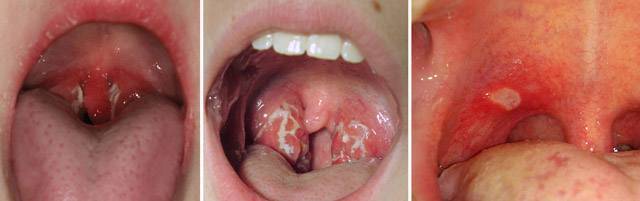 Стоматит в горле у ребенка (с фото): способы лечения язвочек на миндалинах