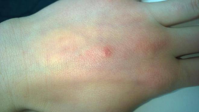 Мазь от укусов насекомых для детей: чем лечить опухоль и покраснение, как снять отек?