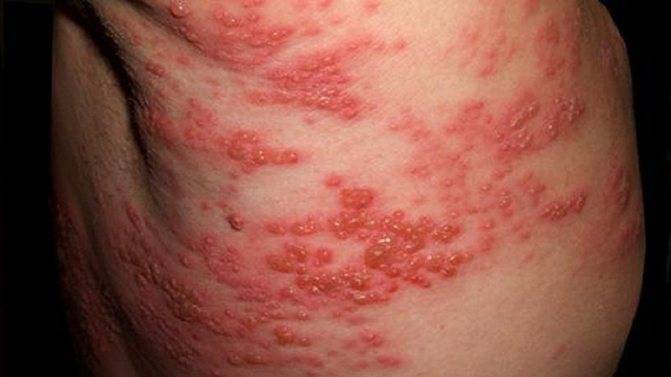 Опоясывающий лишай у детей - симптомы и лечение вируса герпес Зостер