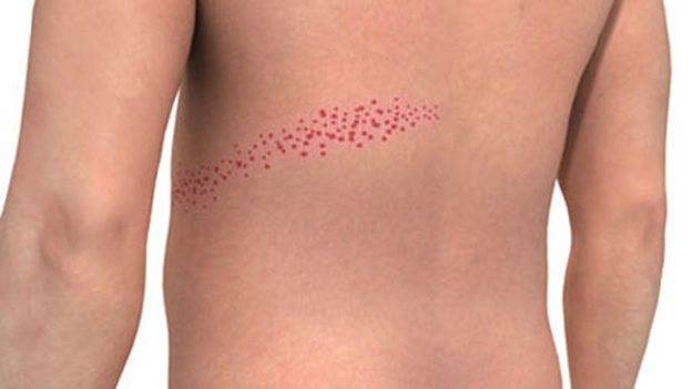 Опоясывающий лишай у детей - симптомы и лечение вируса герпес Зостер