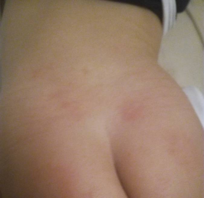 Шершавые пятна на теле у ребенка (на коже ног и рук, на спине и лице): фото